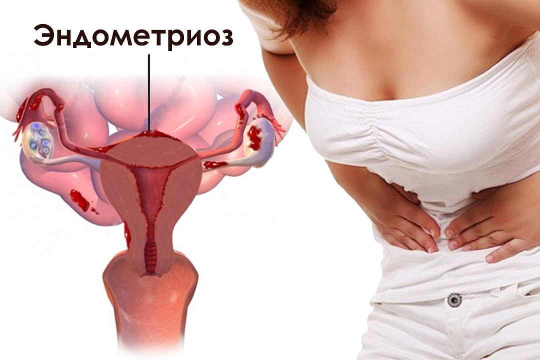 - Эндометриоз: как отличить от обычных болей
